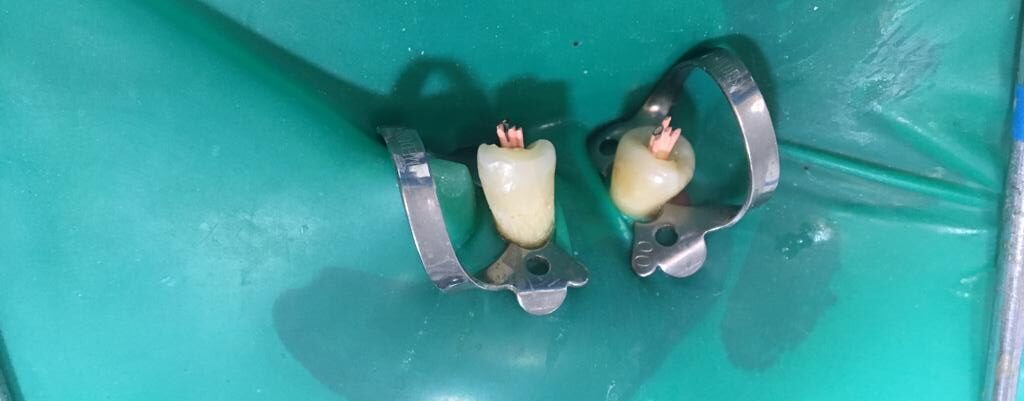 alt=“img endodoncia 1”