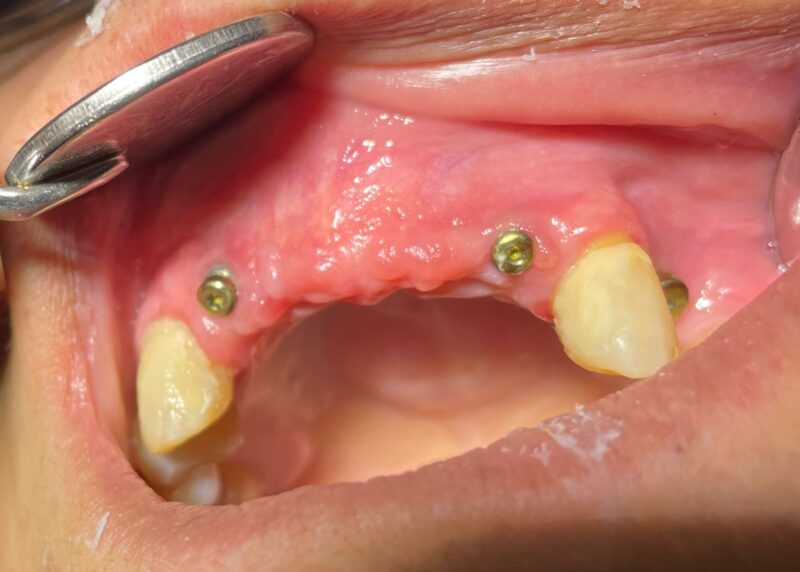 alt=“img Implantes dentales Cartagena 2”