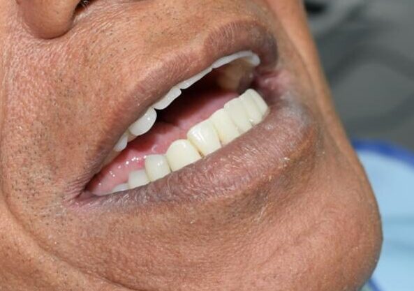 alt=“img Prótesis dentales 1”